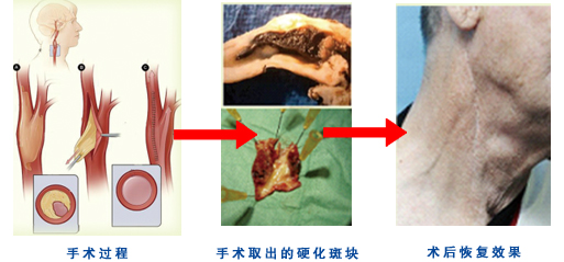 颈动脉内膜剥脱术(CEA)