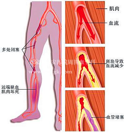 动脉硬化闭塞症到哪儿治疗好？